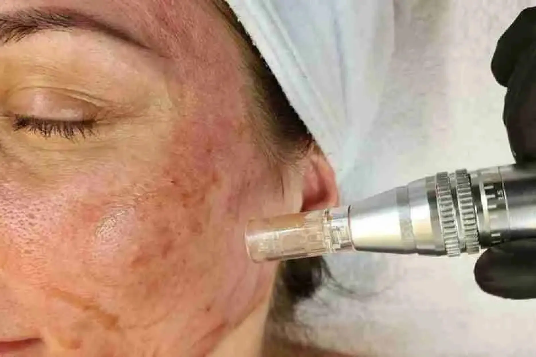 Microagulhamento e Tratamento de Melasma